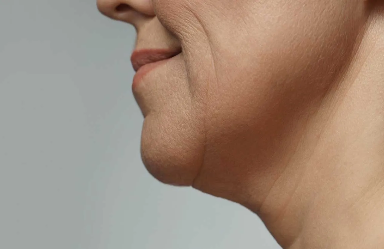 Boyun Bölgesindeki Sarkmalar Nasıl Tedavi Edilir?