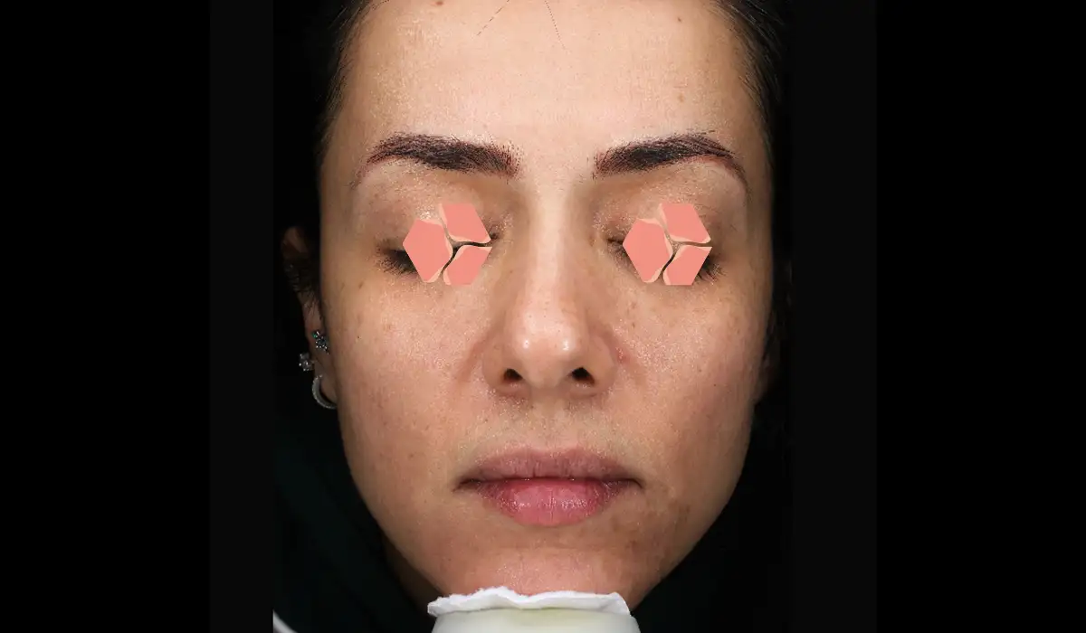 Cilt Yenileme ve Gençleştirme BA 2