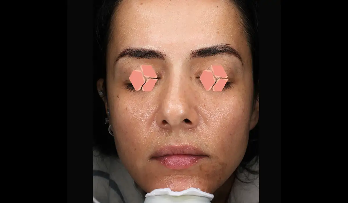 Cilt Yenileme ve Gençleştirme BA 2