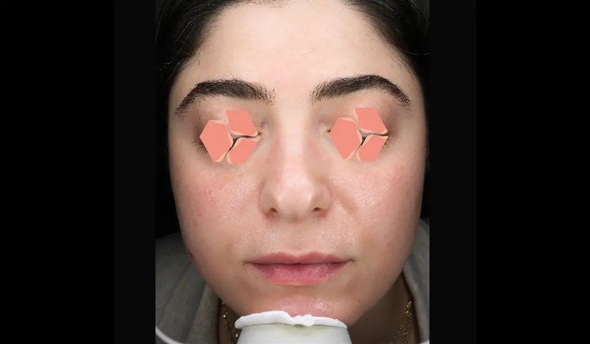 Güneş ve Yaşlılık Lekeleri BA 2