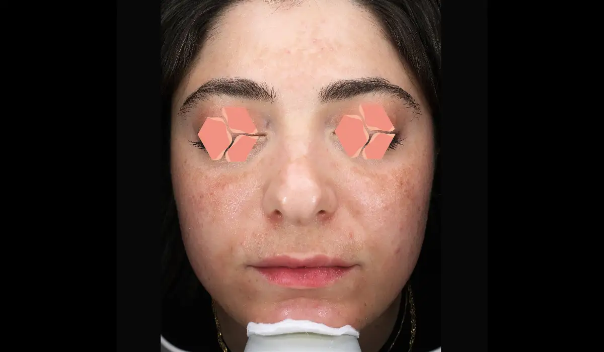 Güneş ve Yaşlılık Lekeleri BA 2