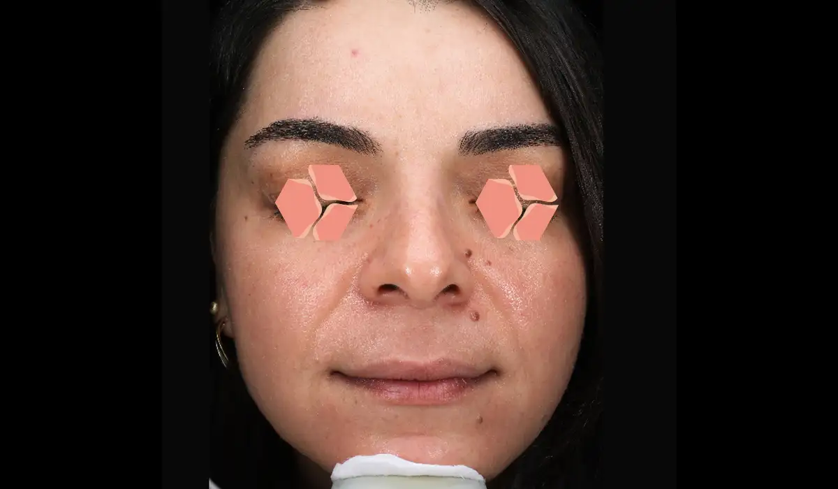 Güneş ve Yaşlılık Lekeleri BA 3