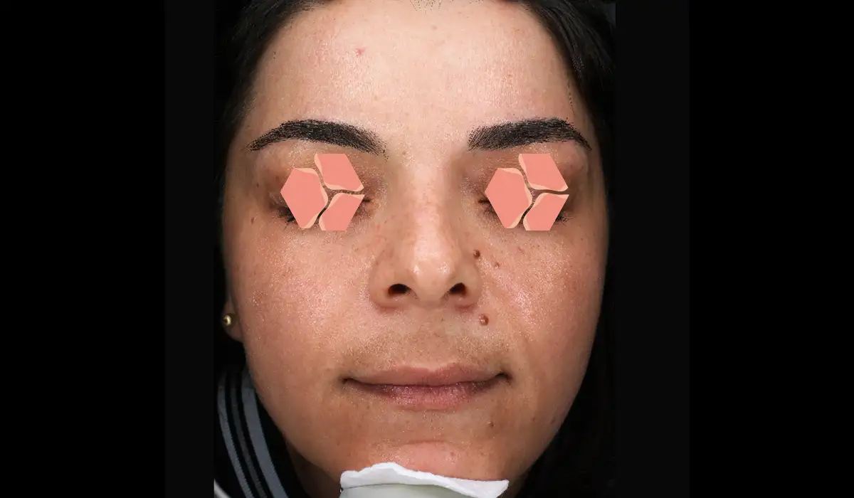 Güneş ve Yaşlılık Lekeleri BA 3