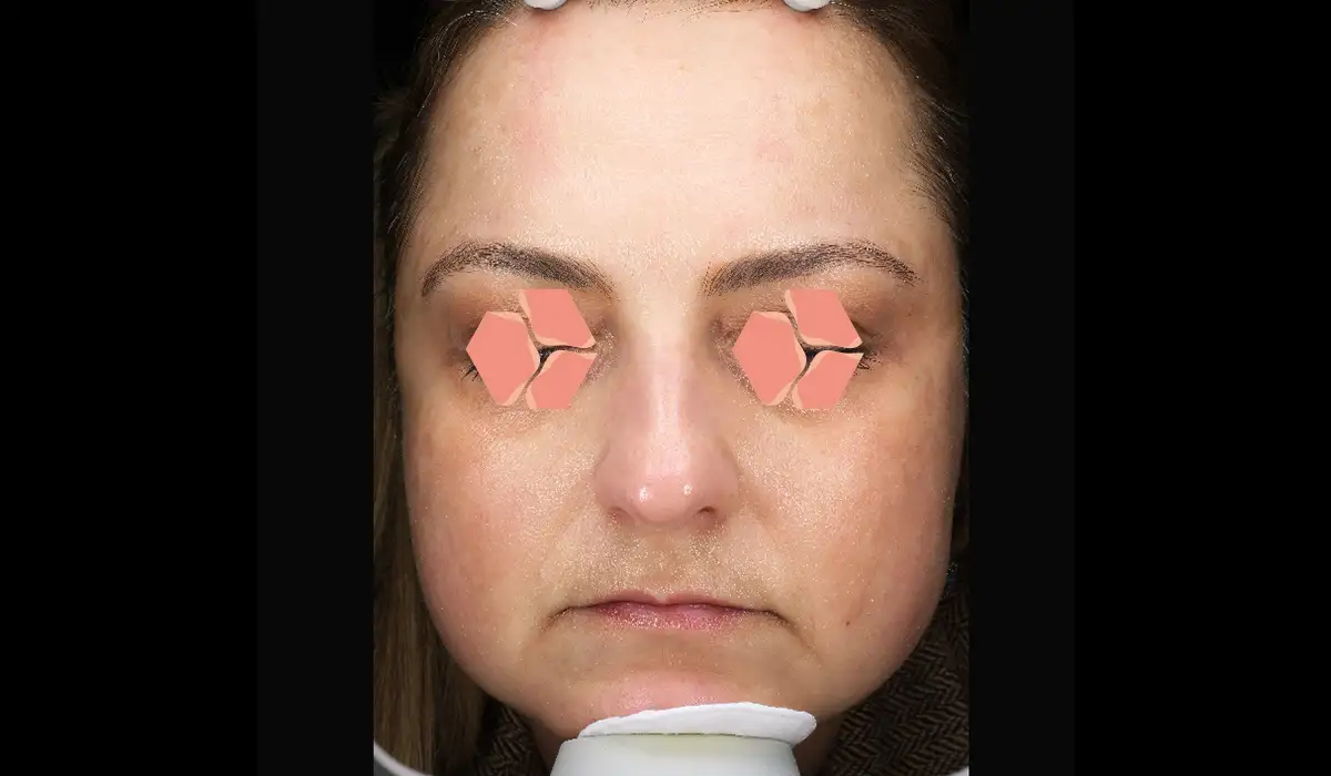 Güneş ve Yaşlılık Lekeleri BA 4