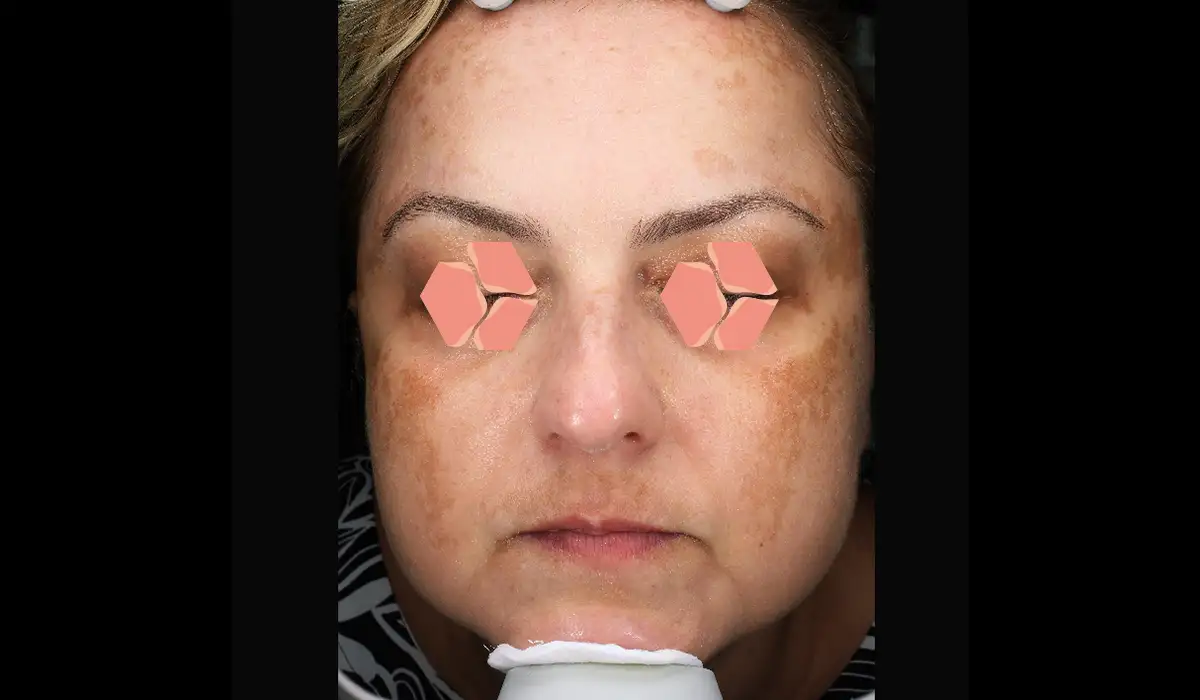 Güneş ve Yaşlılık Lekeleri BA 4