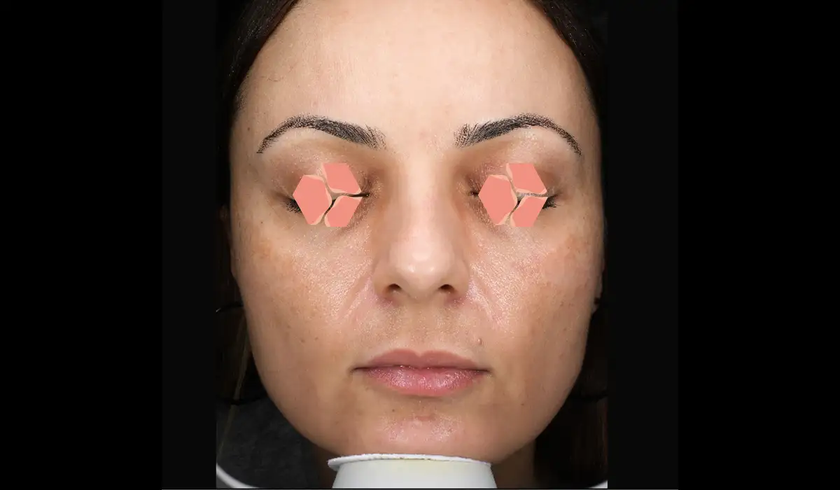 Güneş ve Yaşlılık Lekeleri BA 5