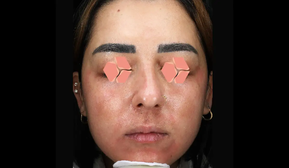 Güneş ve Yaşlılık Lekeleri BA 6