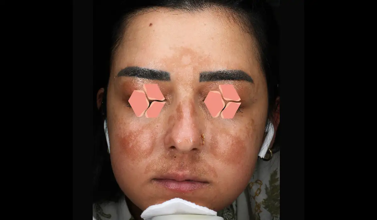 Güneş ve Yaşlılık Lekeleri BA 6