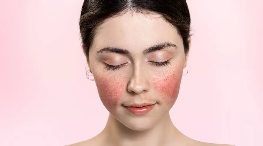 Rozasea (Gül Hastalığı)