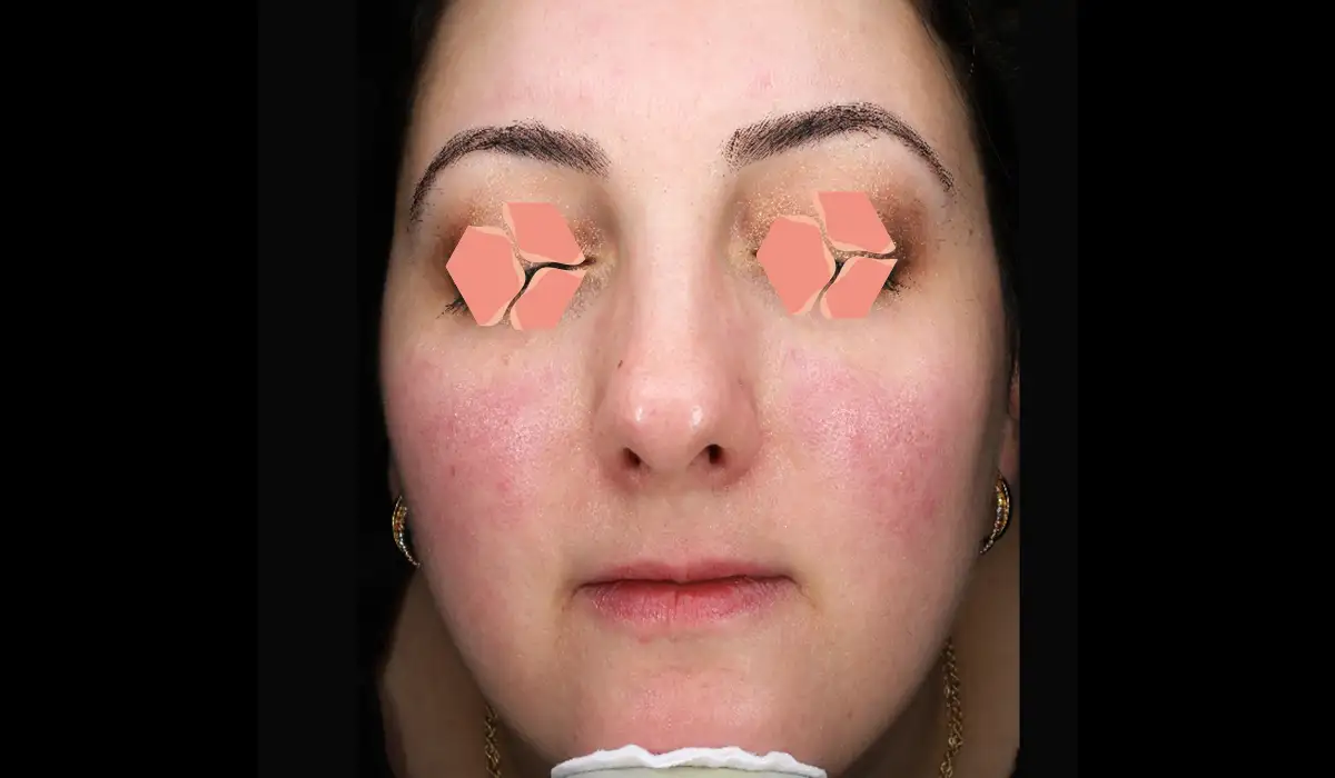 Rozasea (Gül Hastalığı) BA 2