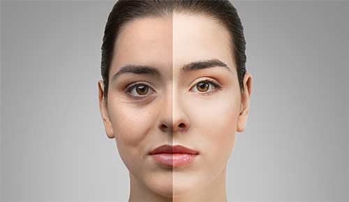 Terleme Azaltılması