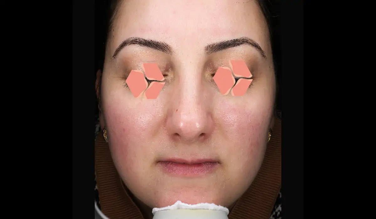 Yüz Kızarıklığı ve Damarlanmalar BA 2