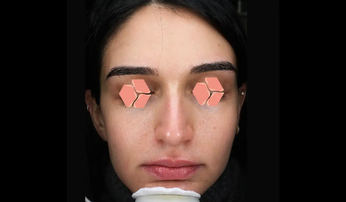 Yüz Kızarıklığı ve Damarlanmalar BA 3