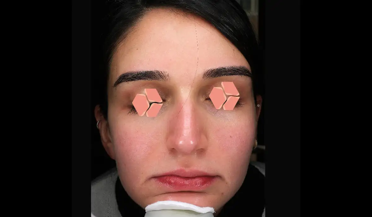 Yüz Kızarıklığı ve Damarlanmalar BA 3