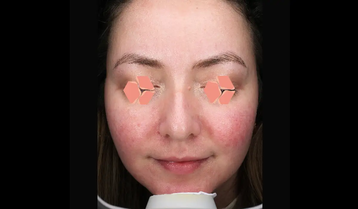 Yüz Kızarıklığı ve Damarlanmalar BA 4