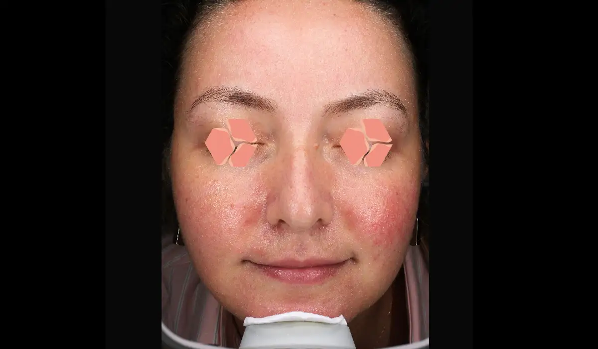 Yüz Kızarıklığı ve Damarlanmalar BA 4